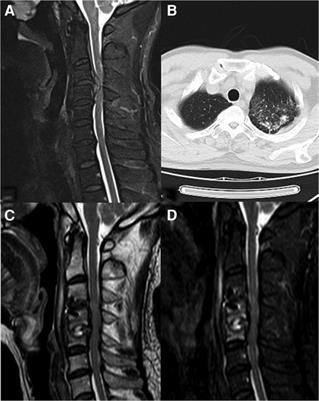 Secondary tuberculosis of adjacent segments after anterior cervical discectomy and fusion: A case report